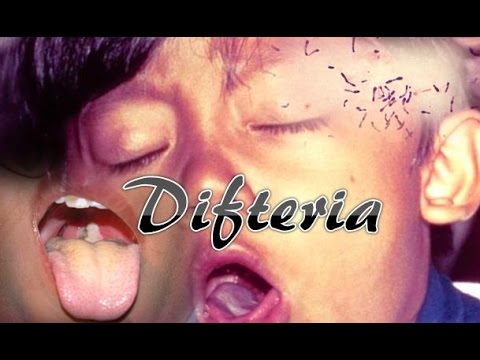 difteri